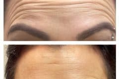 forehead-dysport-
