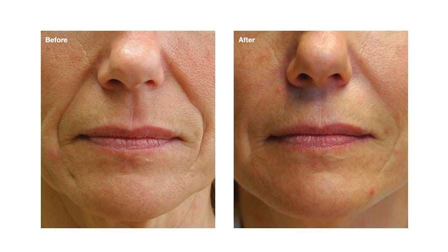 Non surgical facelift options B and A Non surgical facelift options B and A