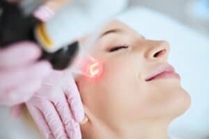 laser skin treatment ft myers